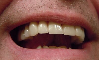 reference_teeth1
