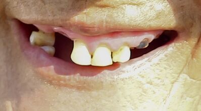 reference_teeth4
